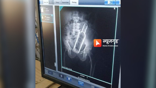 निकालियो पेटभित्रको रक्सीकाे बोतल